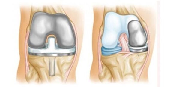 artroplastyka w przypadku artrozy stawu kolanowego