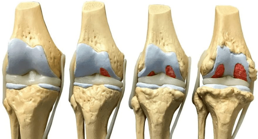 uszkodzenie stawu kolanowego na różnych etapach rozwoju artrozy