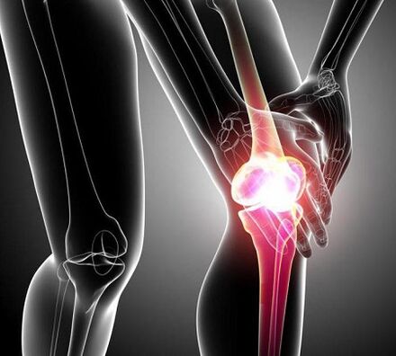 uszkodzenie stawu kolanowego z zapaleniem stawów i artrozą