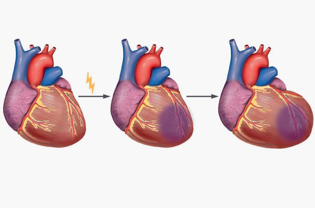 Zawał mięśnia sercowego prowadzi do bólu łopatek