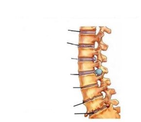Objawy osteochondrozy