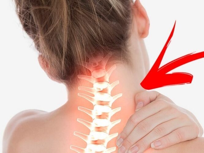 Kompresja korzeni nerwowych z osteochondrozą szyjną