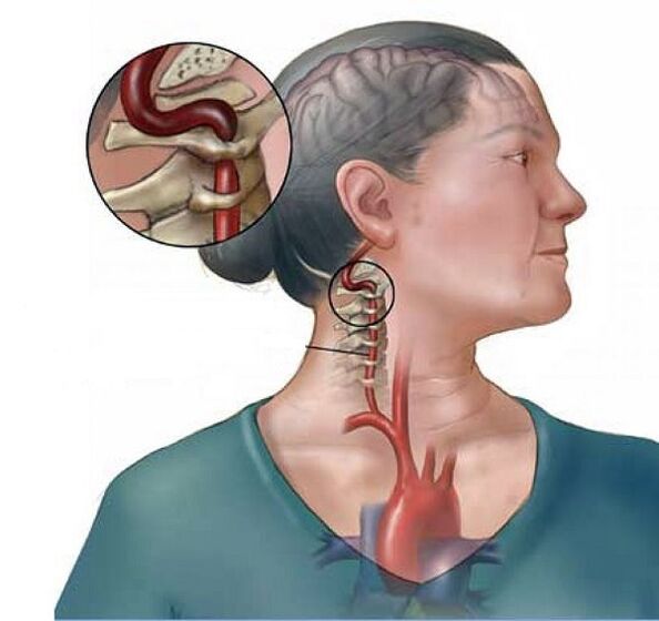 zespół tętnicy kręgowej z osteochondrozą szyjną