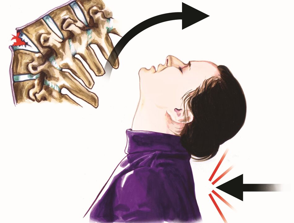 uszkodzenie kręgosłupa jako przyczyna bólu szyi