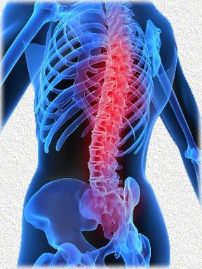 osteochondroza i metody jej leczenia