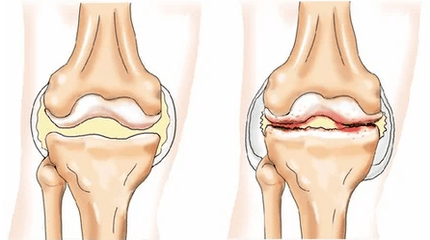 Chondromatoza